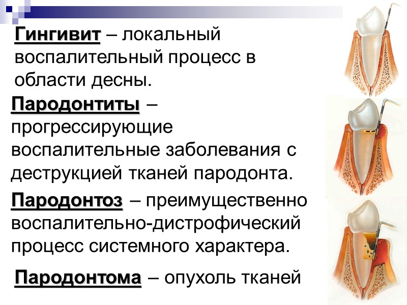 Пародонтиты – прогрессирующие воспалительные заболевания с деструкцией тканей пародонта. Пародонтоз – преимущественно воспалительно-дистрофический процесс